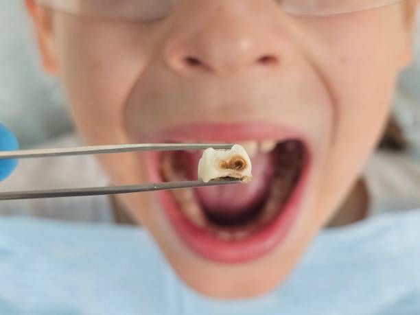 Best Knocked-Out Tooth (Avulsed Tooth) Treatment in Shields, MI
